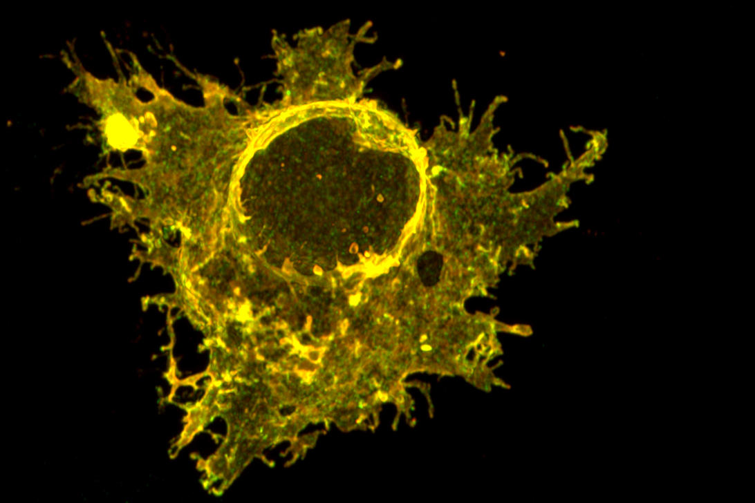 Image microscopique d'un mélanome humain