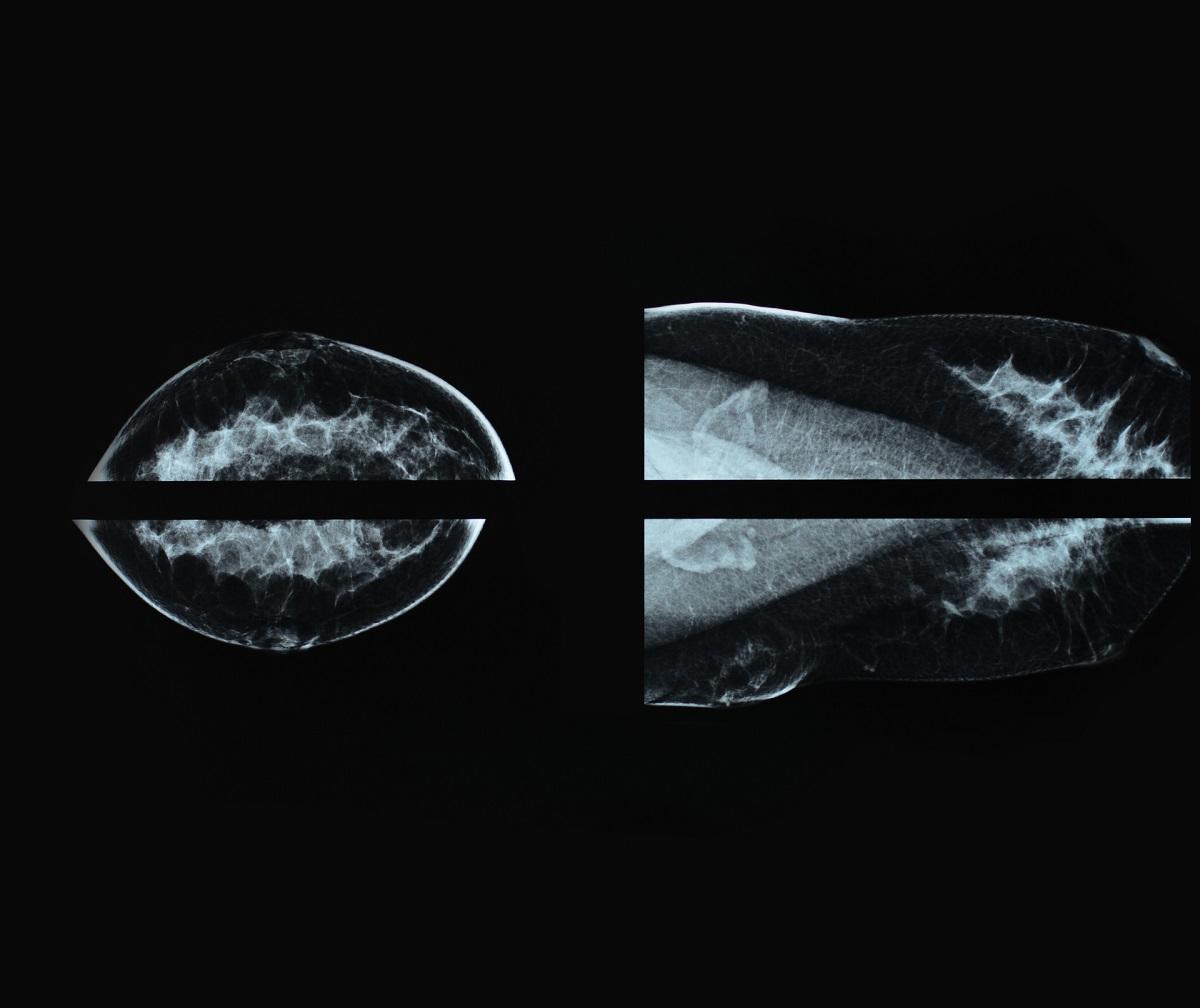 Mammographie Image de film de radiographie