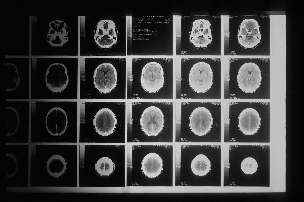 brain tumour
