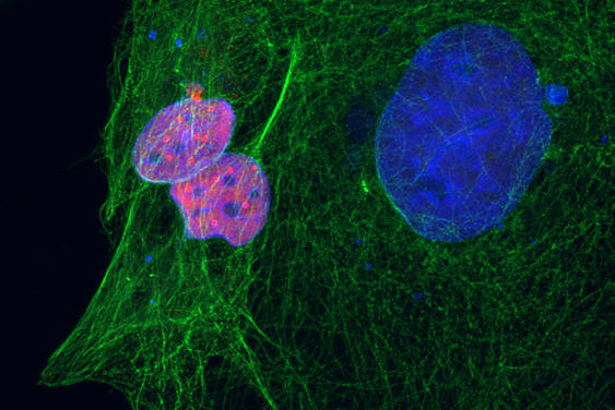 Image de cellules de cancer du sein humain
