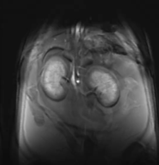 mage IRM d'une perfusion rénale