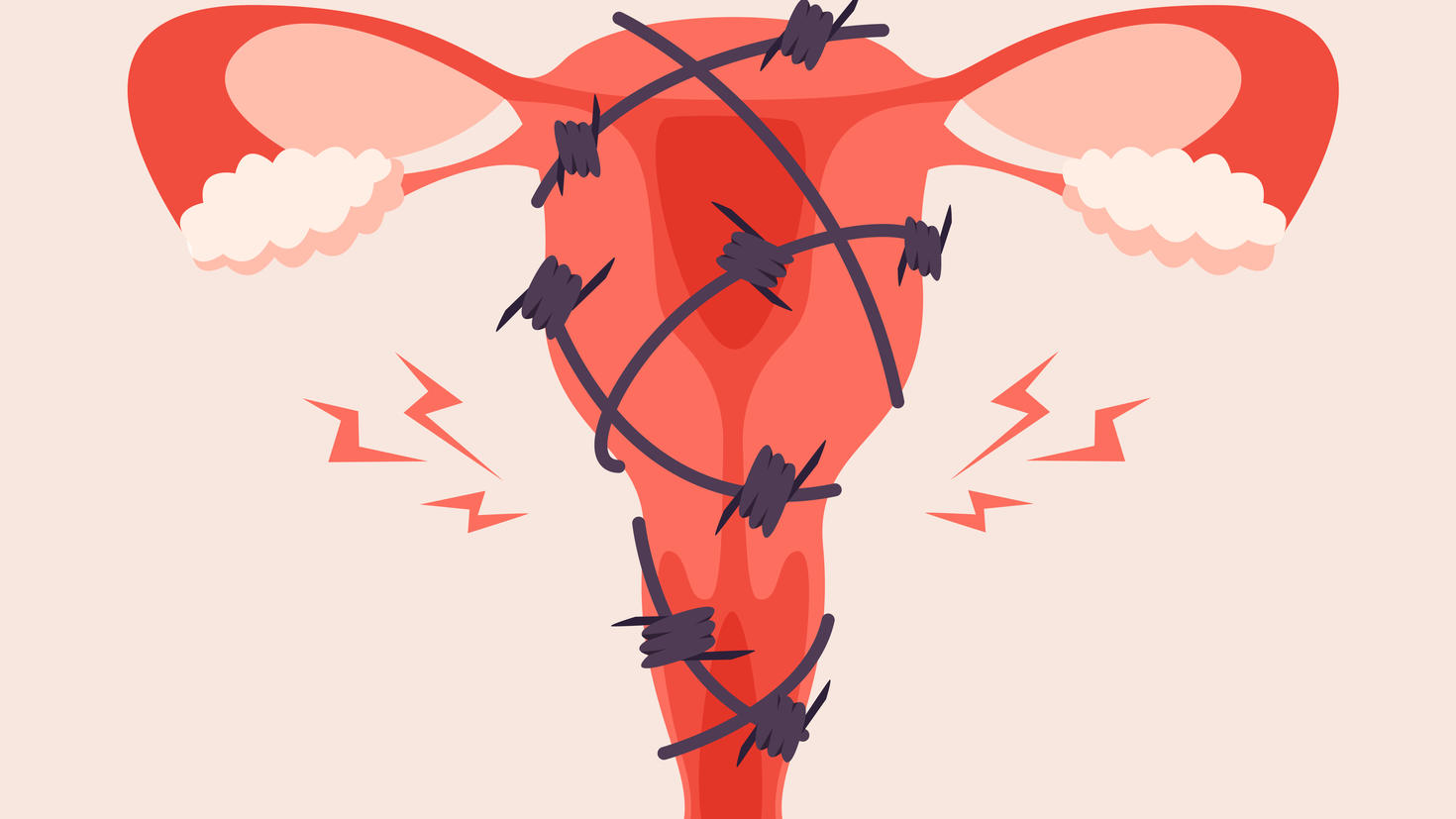 Image de l'utérus avec du fil de fer barbelé.