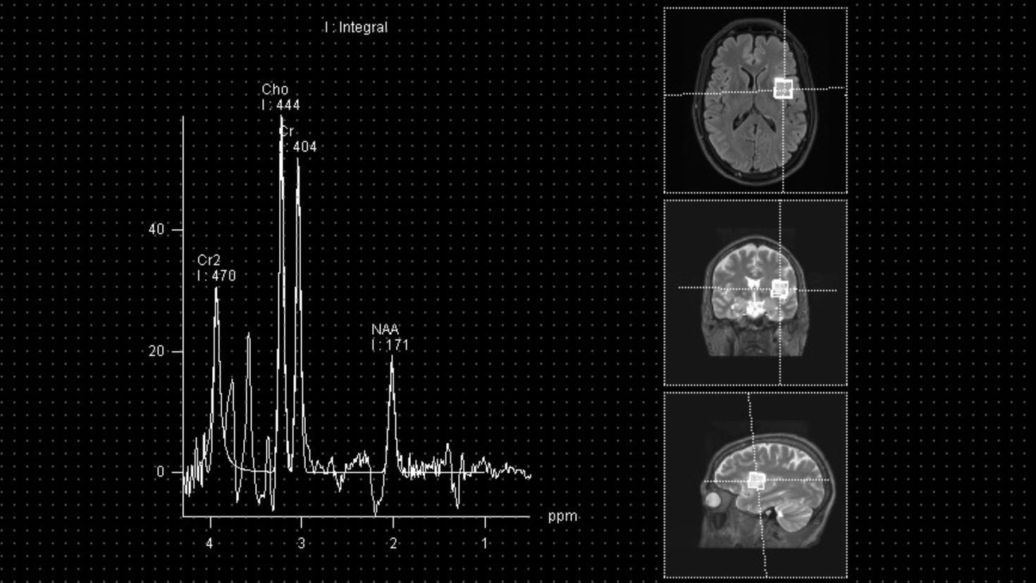 IRM d'un gliome de haut grade dans le cerveau d'un patient et graphiques montrant les métabolites anormaux dans le gliome.