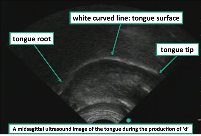 Une image échographique midsagittale de la langue pendant la production du son 'd'. Identifié sur l'image de gauche à droite: La racine de la langue, ligne blanche courbée : la surface de la langue et le bout de la langue.