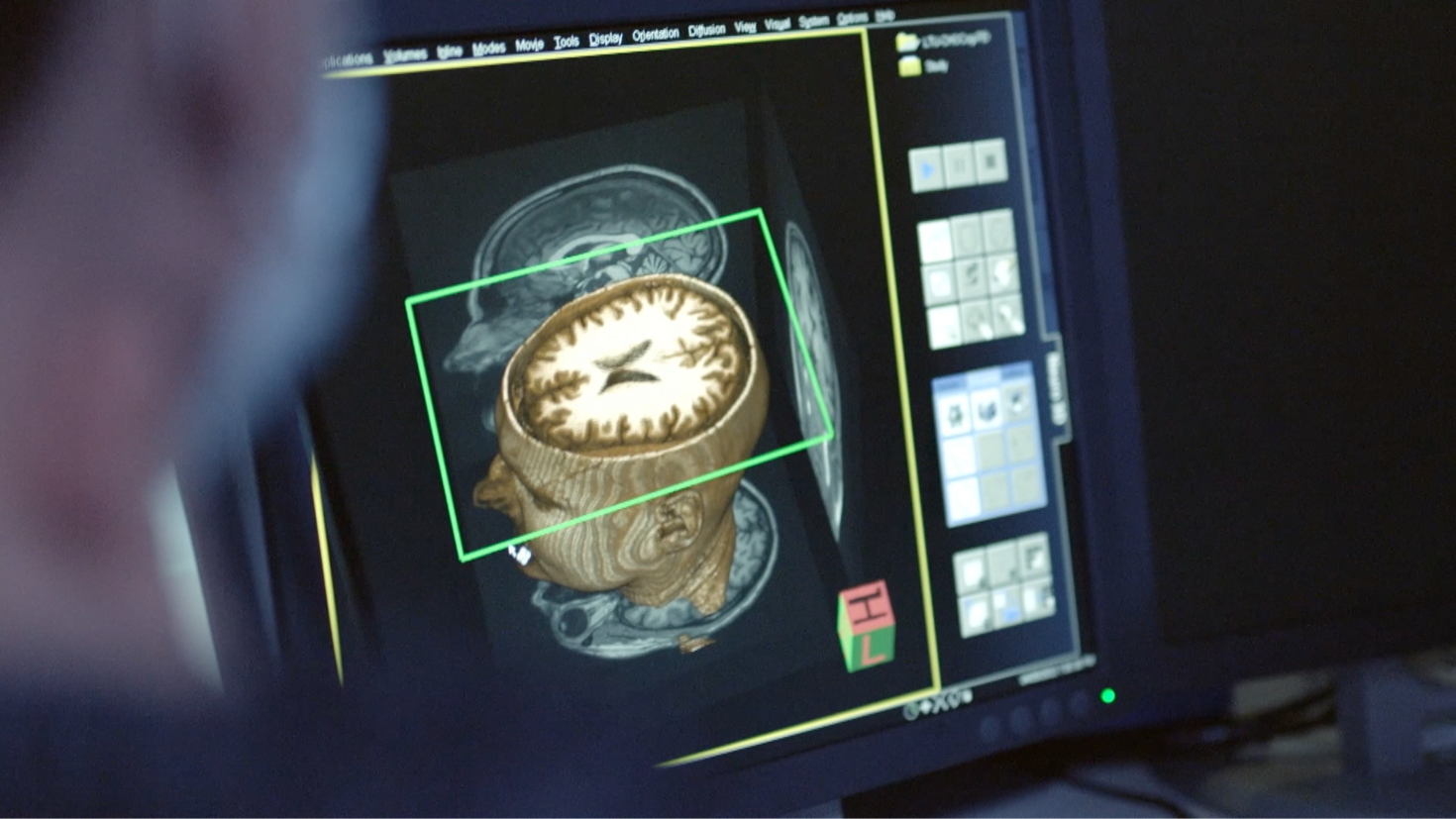Une IRM en 3D d'un cerveau humain s'affiche sur l'écran d'un ordinateur.