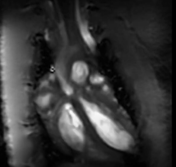 Beating heart MRI