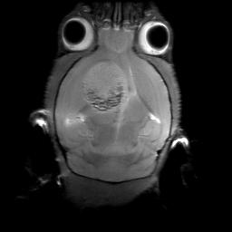 MRI image of brain tumor