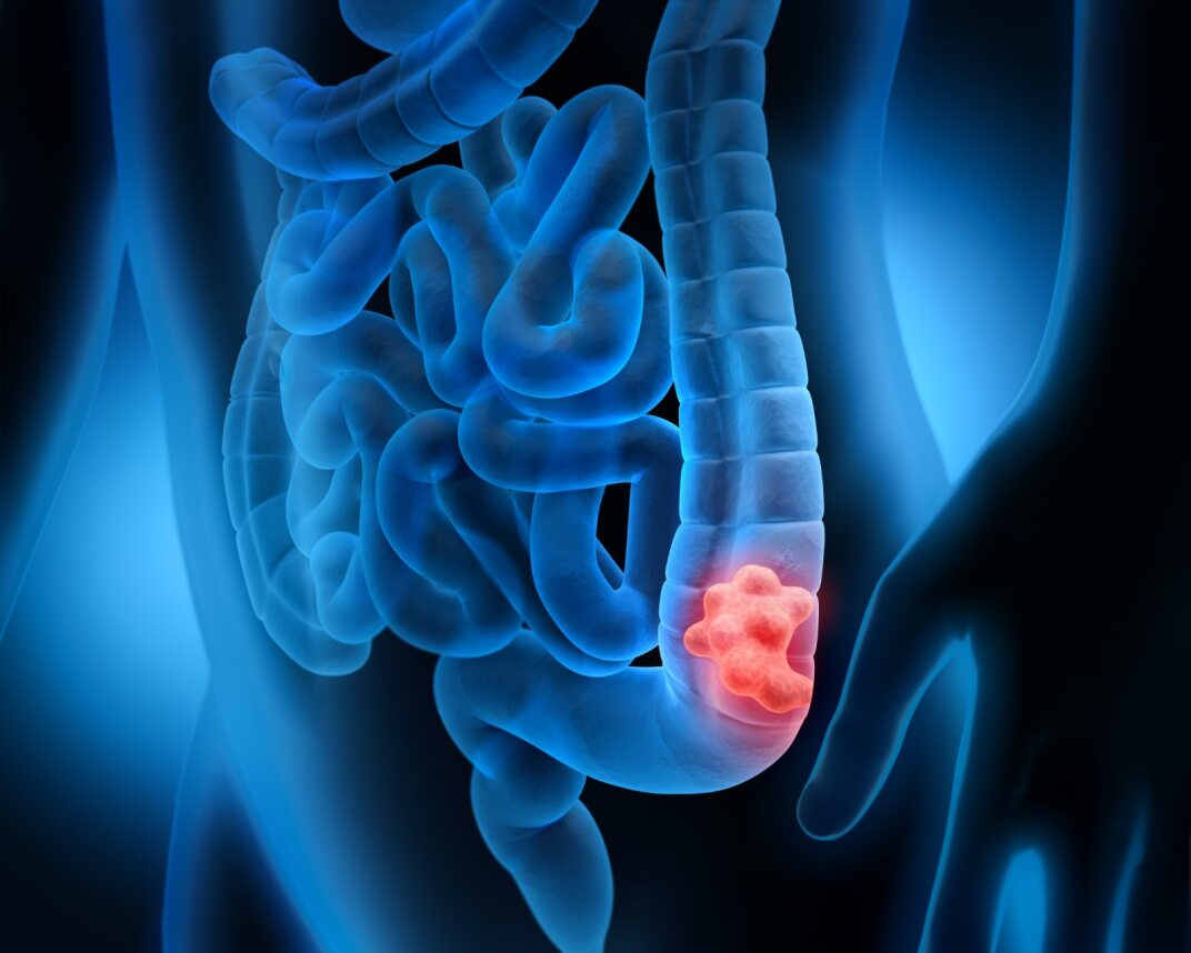 Graphic showing cancer inside colon