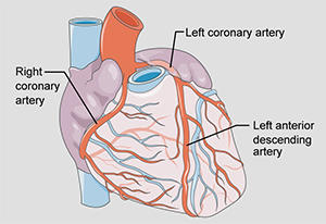 Illustration du cœur humain présentant les artères coronaires, dont l'artère descendante antérieure gauche dont l'obstruction provoque la crise cardiaque du faiseur de veuves.